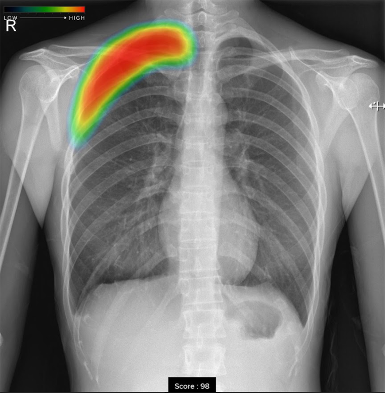 富士フィルム社製のC@RNACOREと胸部X線画像病変検出ソフトウェア EX-Mobile（医療AI解析）