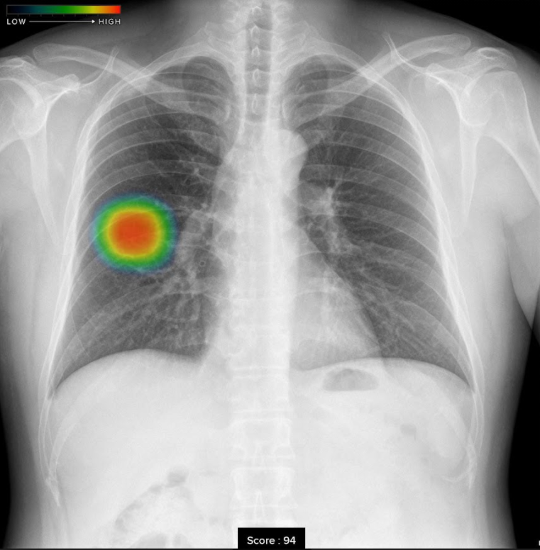 富士フィルム社製のC@RNACOREと胸部X線画像病変検出ソフトウェア EX-Mobile（医療AI解析）